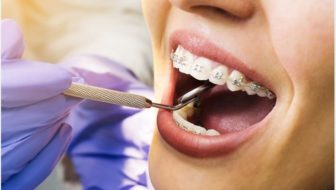 Braces