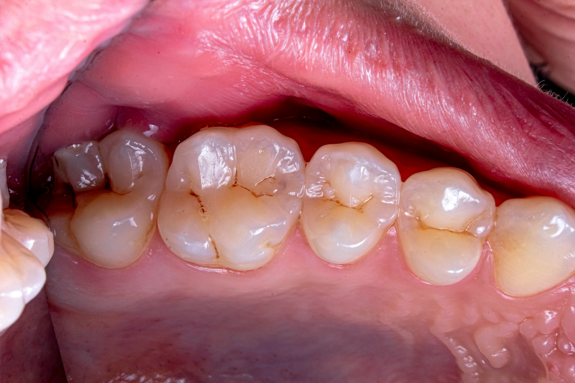 Understanding Gum Disease: Prevention, Treatment, and the Role of Regular Dental Care
